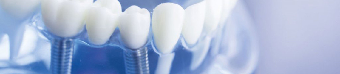 Zobni implantat